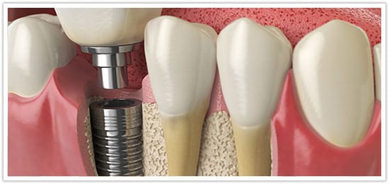 Dental bone graft cost