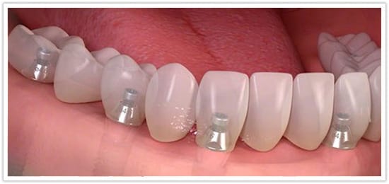 Full mouth dental implants