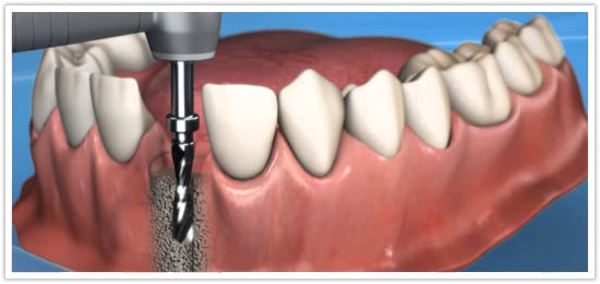 Low cost dental implants