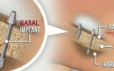 Basal Implants in USA Vs. India