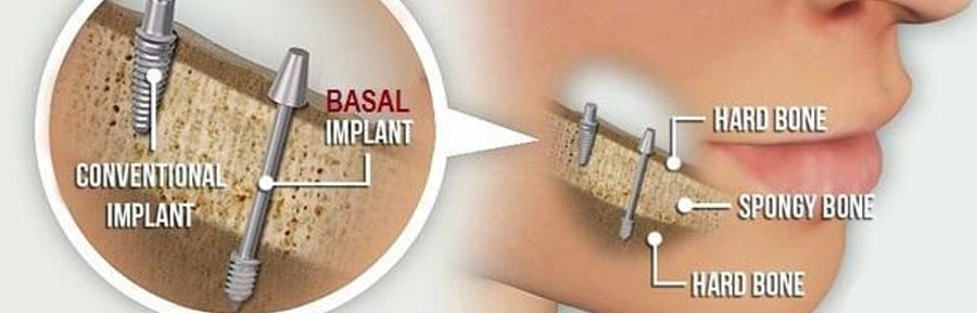 Basal Implants in USA Vs. India