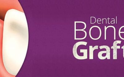 What is a Dental Bone Graft?
