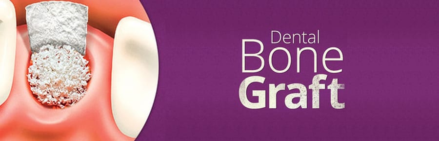 What is a Dental Bone Graft?