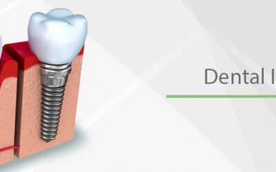 5 Things You Should Know About Dental Implants