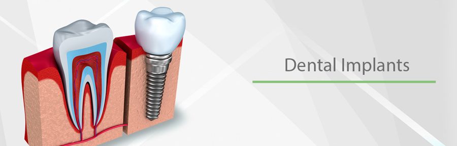 5 Things You Should Know About Dental Implants