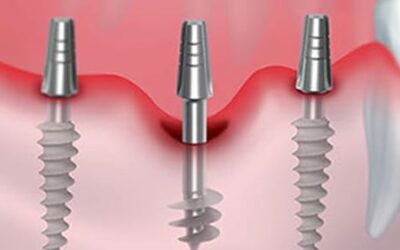 Benefits of Getting Basal Implants in Hyderabad