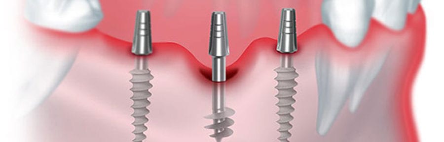 Basal implants in Canada basal implants in hyderabad, basal implants in USA,