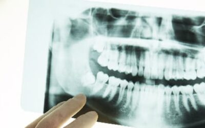 When Do You Need a Bone Graft Dental Implant?