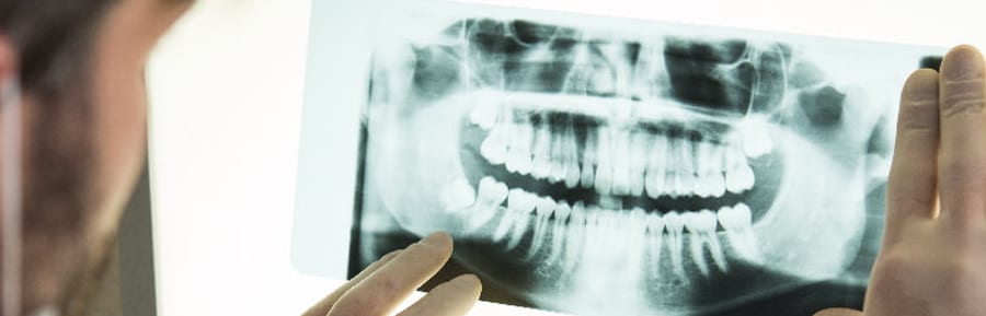 When Do You Need a Bone Graft Dental Implant?
