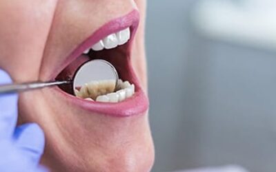 Overview of Bone Graft Dental in Canada