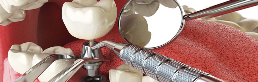 Why Bone Grafting Before Dental Implants?