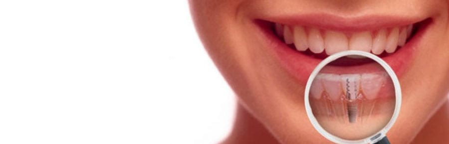 implant denture cost in India