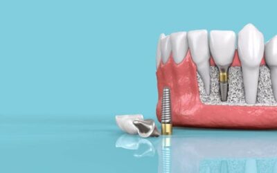 The Evolution of Dental Implant Materials