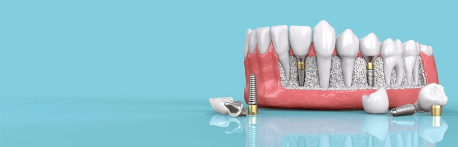 The Benefits of Dental Implants: A Comprehensive Guide