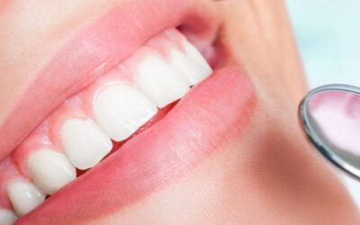 How to Clean Dental Implants?