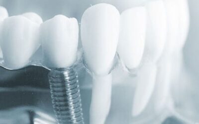 Pros of the Same Day Dental Implants in India