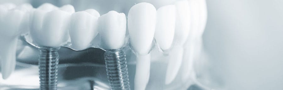 Pros of the Same Day Dental Implants in India