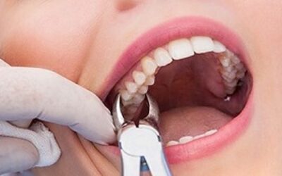 Signs Your Wisdom Teeth Need to Come Out