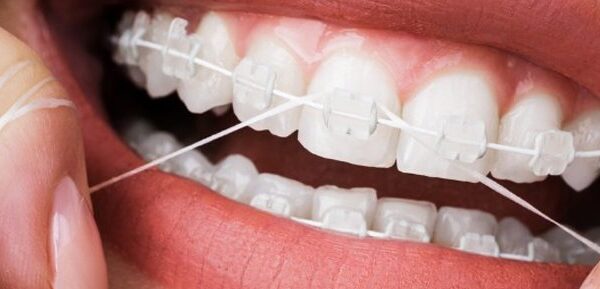 Flossing with braces on