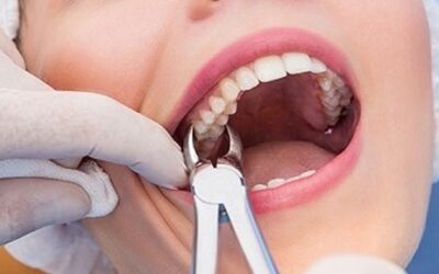 Wisdom Teeth: Friend or Foe?