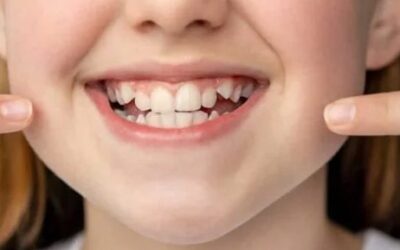 How Can I Straighten Crowded Teeth?