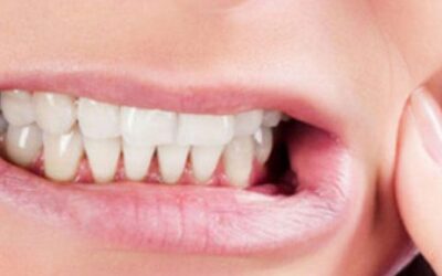 Ways to Combat Teeth Grinding