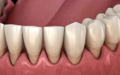 How Do You Fix Gum Recession?