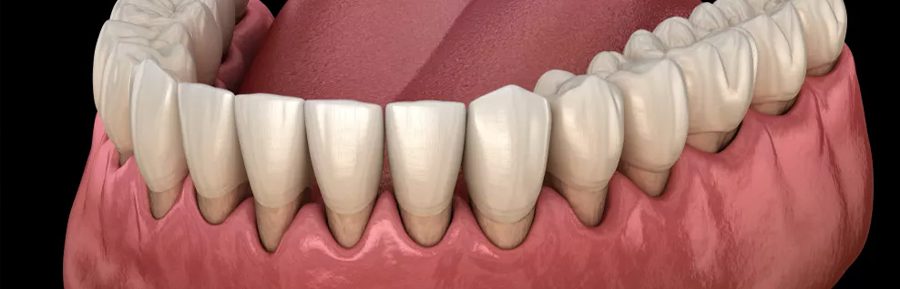 How Do You Fix Gum Recession?