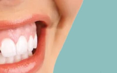 What is a Gummy Smile?