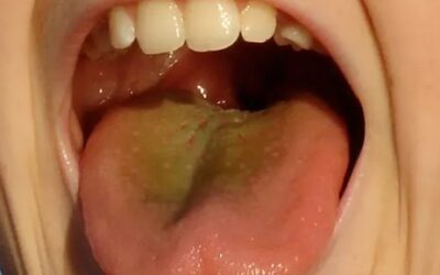 What is a Black Tongue?