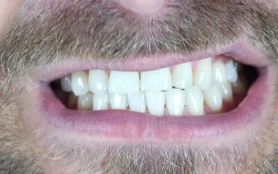 7 Ways to Stop Teeth Grinding