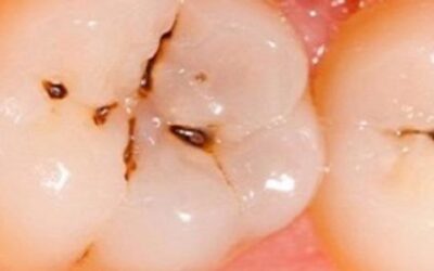 How To Prevent Cavities?