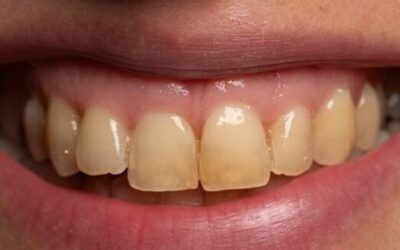 Reasons and Remedies for Tooth Discoloration