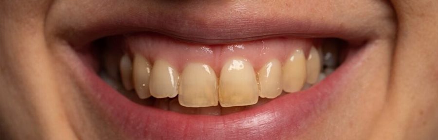 Reasons and remedies for tooth discoloration
