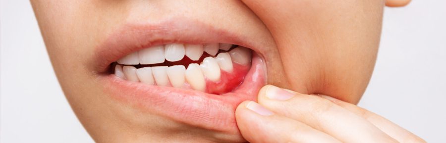 Long term effects of gum disease