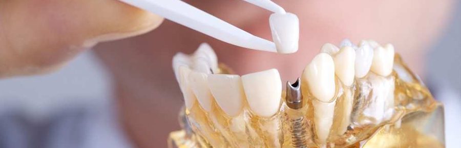 Restore your smile with dental implants