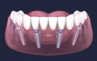 All-on-4 Dental Implants: A Game-Changer