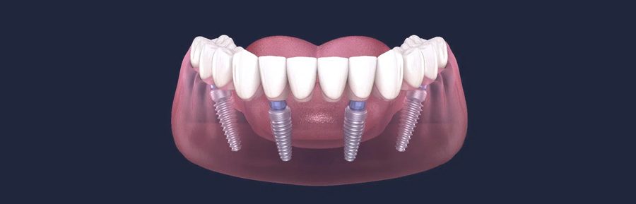 All-on-4 Dental Implants: A Game-Changer