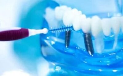 How to Care for Your Dental Implants: Maintenance Tips