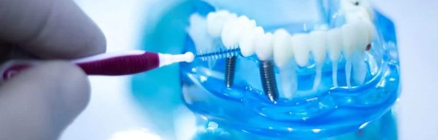 How to care for your dental implants: maintenance tips