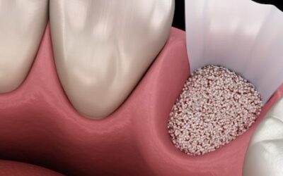 Say Goodbye to Bone Grafts: The Basal Implant Advantage