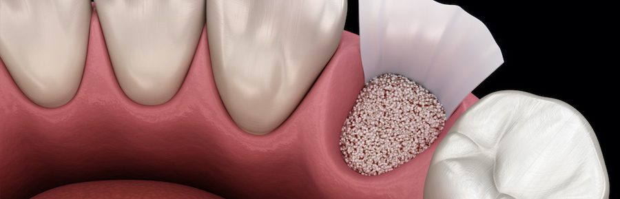 Say Goodbye to Bone Grafts: The Basal Implant Advantage