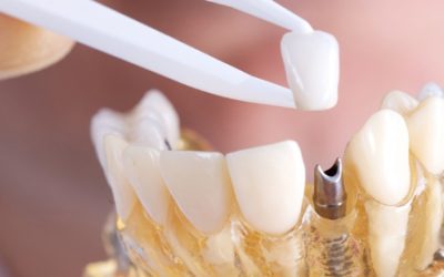 Cheap Implants Abroad: Why India is the Smart Middle Ground