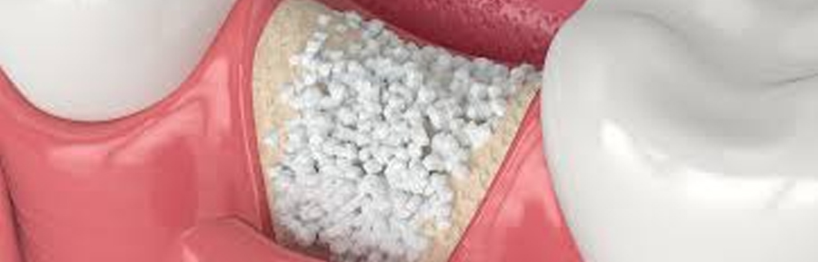 Bone Grafts Are So Last Decade: New Tech Makes Them Obsolete