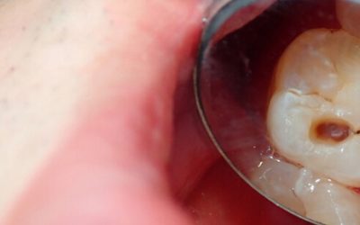 Role of Genetics: Why Some People Are More Prone to Cavities