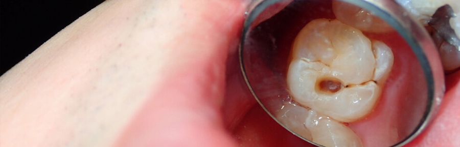 Role of Genetics: Why Some People Are More Prone to Cavities