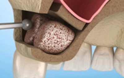 Sinus Lifts Are Extinct: New Technology Makes Them Unnecessary