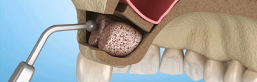 Sinus Lifts Are Extinct: New Technology Makes Them Unnecessary