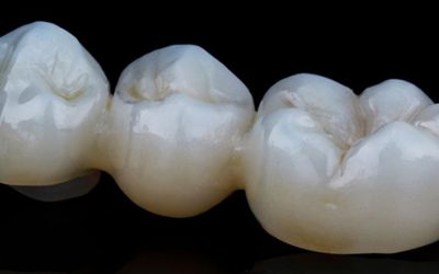 Zirconia Crowns: Enter the Era of Same-Day Restorations