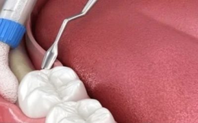 When Bone Grafts Go Wrong: 5 Terrifying Outcomes You Can Avoid